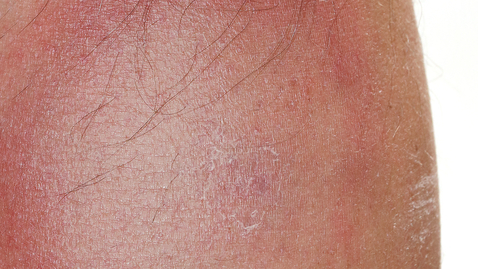 Thumbnail for What Is Lyme Disease?