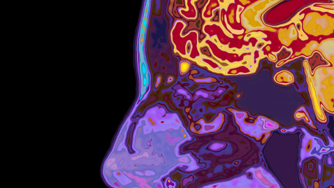 Thumbnail for Dementia with Lewy Bodies