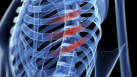 Thumbnail for Fractured Ribs Still Painful After 2 Months? You May Need Surgery