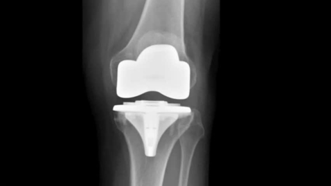 Thumbnail for Total Knee Replacement