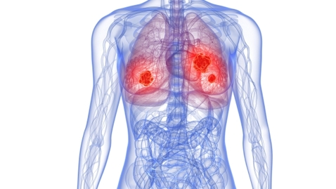 Thumbnail for The Most Dangerous Cancer for Women Isn’t Breast Cancer