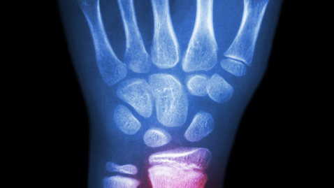 Thumbnail for Can You Always See a Fracture in an X-Ray?