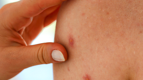 Thumbnail for New Shingles Vaccine: Who's it For and What it Does