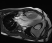 Panel B Clip: Hypertrophic cardiomyopathy