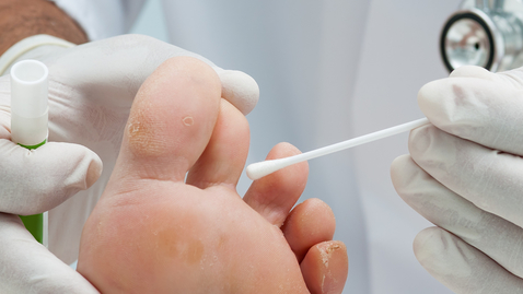 Thumbnail for Best Ways to Treat a Nail Fungus