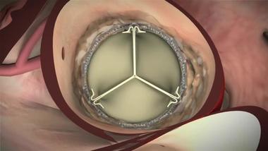 Tavr Heart Procedure Aortic Stenosis Treatment University Of