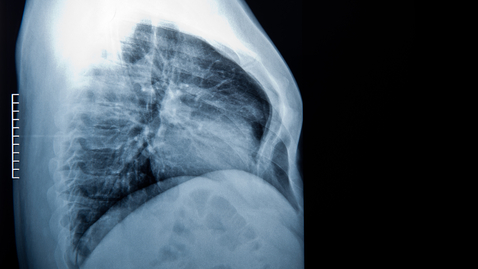 Thumbnail for What Is Funnel Chest and How Is It Treated?