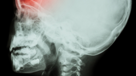 Thumbnail for How Do I Know if My Child Has Craniosynostosis? 