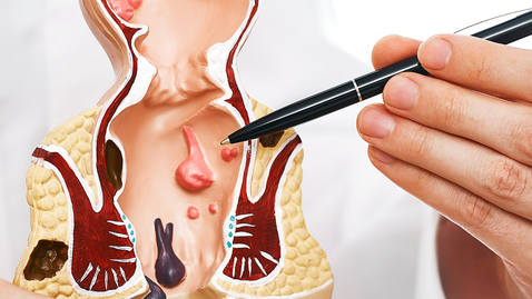 Thumbnail for Correcting Common Colorectal Cancer Misconceptions