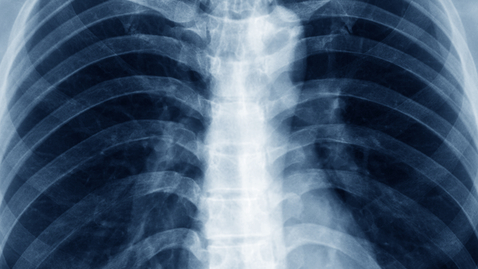 Thumbnail for What Is Pigeon Chest and How Is it Treated?