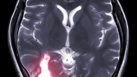 Thumbnail for What Treatments are Available for Drug-resistant Epilepsy?