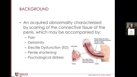 Thumbnail for entry Men's Health Seminar - Erectile Dysfunction &amp; Peyronie's Disease - January 25, 2021