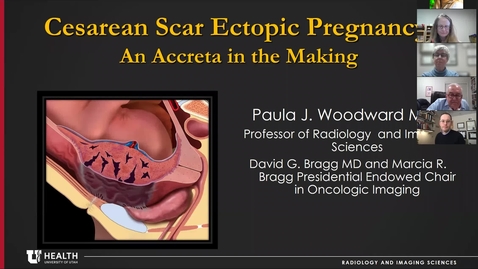 Thumbnail for Cesarean scar ectopic pregancy: An accreta in the making