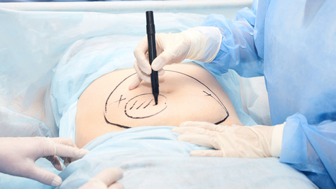 Thumbnail for Tummy Tuck or Liposuction: Which Body Contouring Procedure is Right for You?