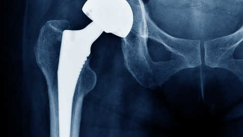 Thumbnail for How to Take Care of Your Joint Replacement