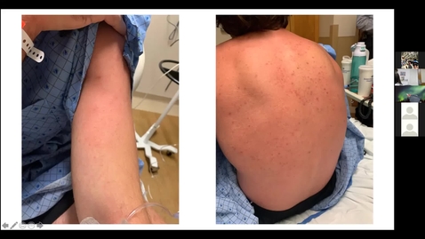 Thumbnail for 9//25/2020 Diving for Oysters: Clinical Teaching Pearls for the Modern Dermatologist