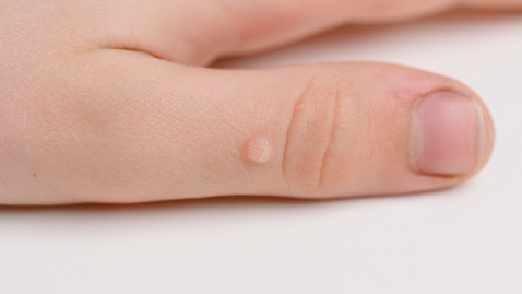 Thumbnail for What Really Works for Treating Warts at Home and in the Clinic