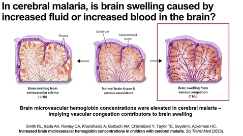 Thumbnail for 5.03 - Dr. Hans Ackerman - Exploring cerebral hemoglobin dynamics in pediatric cerebral malaria using near-infrared spectroscopy