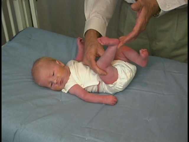 Neurologic Exam-Pediatric | Newborn | Abnormal | Tone - Popliteal Angle